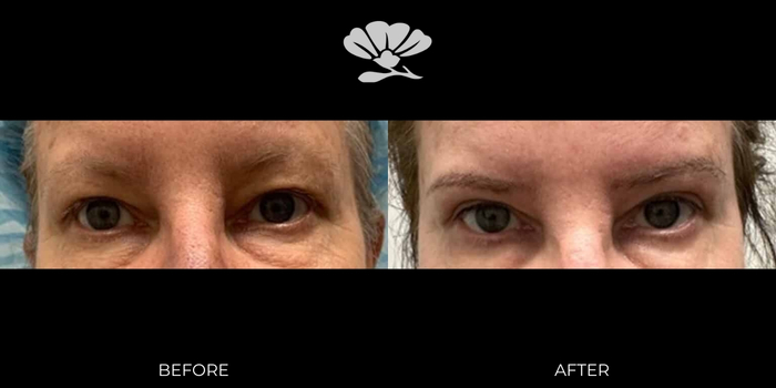 Blepharoplasty before and after Perth eyelid bags