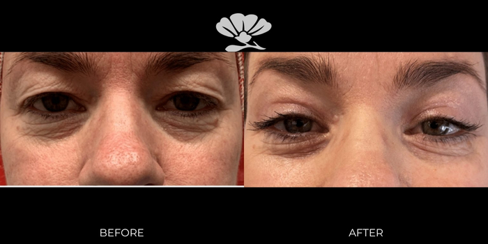 Best Blepharoplasty surgeon before and after Perth eyelid