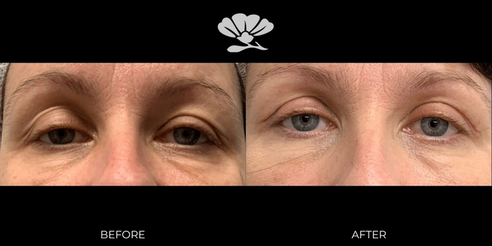 Upper Eyelid Surgery Perth before and after