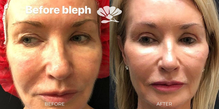 Upper Blepharoplasty surgery before and after Perth