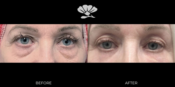 Lower Blepharoplasty and Fat Transfer to Tear Troughs.