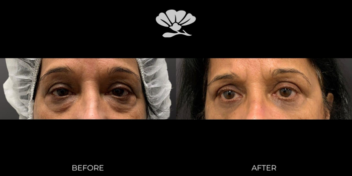 Lower Blepharoplasty with Fat Transfer by Doctor Glenn Murray Perth