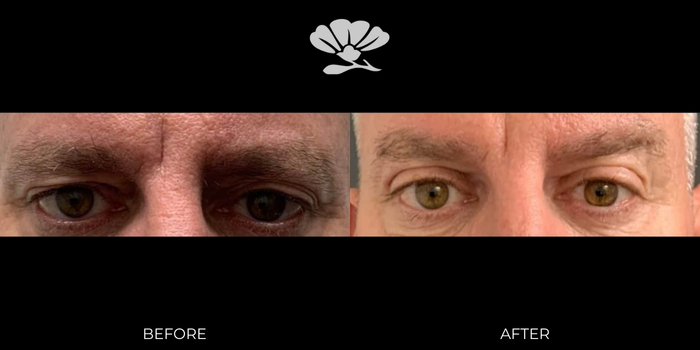 Upper Blepharoplasty and Brow Lift Before and After Perth