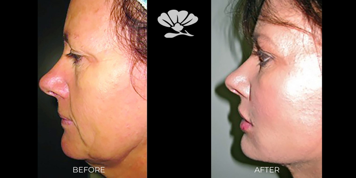 Face lift surgery Perth before and after