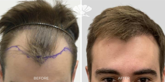 Hair Transplant Perth New Hair Clinic Before and After