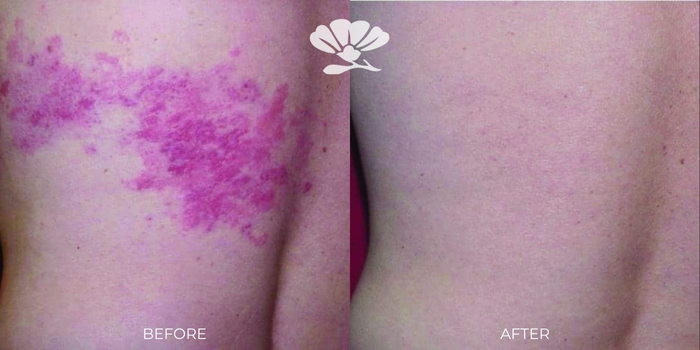Healite II for Psoriasis Perth Before and After