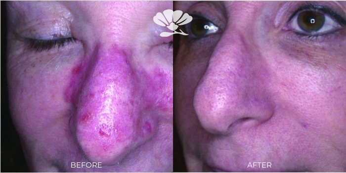 Healite II LED Light Skin Treatment Perth Before and After