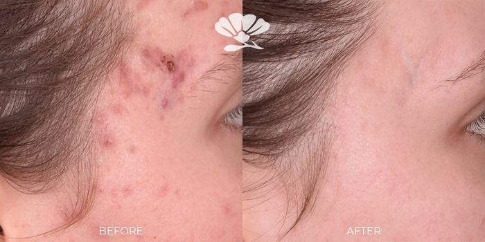 acne treatment perth before and after
