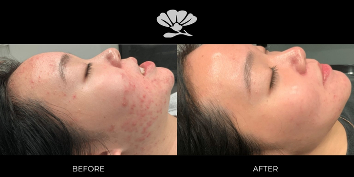 acne scarring treatment perth before and after