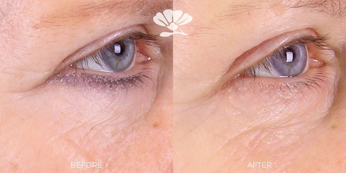 Skin rejuvenation clinic Kleresca before and after