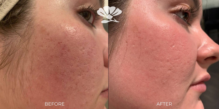 Dot Laser Fractional Before and After Perth