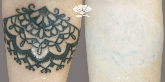 Laser tattoo removal perth before and after