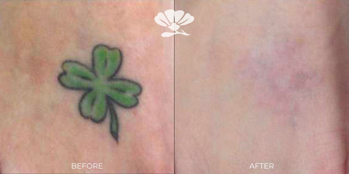 Laser tattoo removal perth before and after