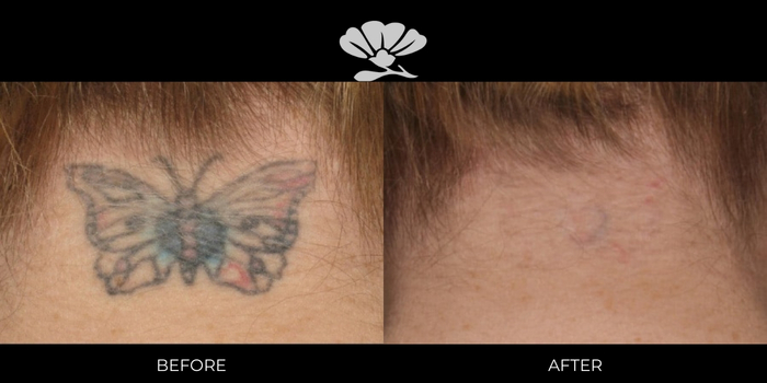 Best Laser tattoo removal Perth before and after