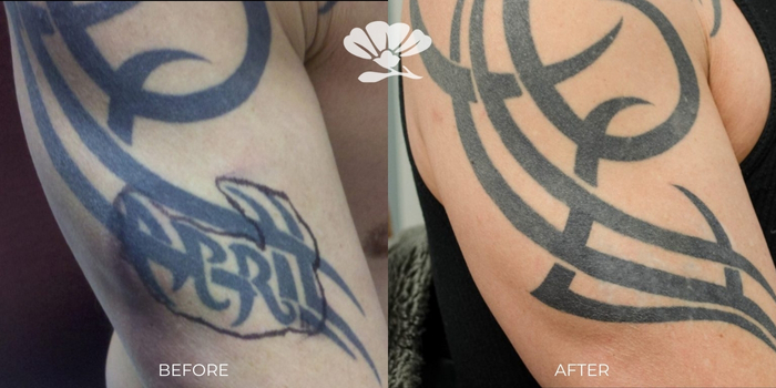South West Laser, Tattoo Removal