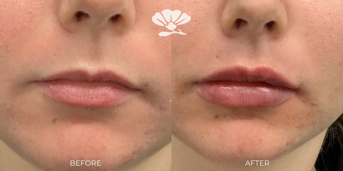 Perth lip filler injections