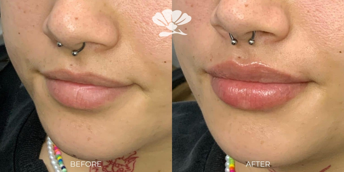 Lip filler 1 ml before and after at our Perth clinic