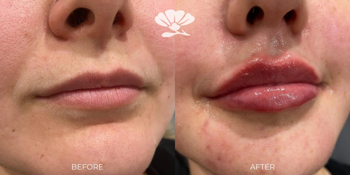 Lip Filler before and After 1 ml Perth