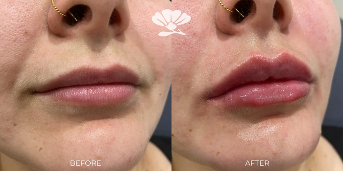 Lip filler before and after photo Perth