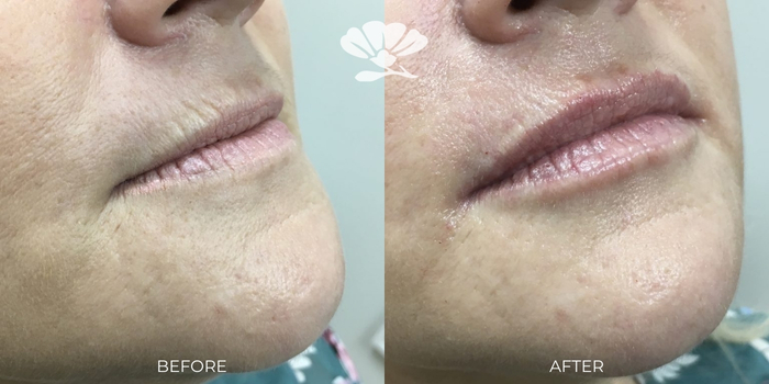 Lip filler Perth clinic. Before and After.