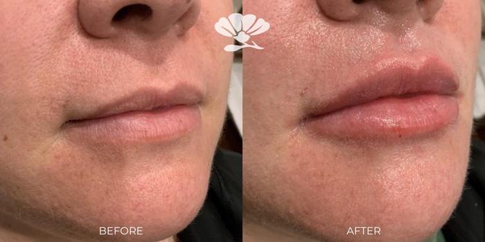 Lip filler Perth before and after photos