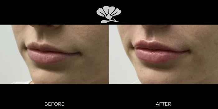 Before and After Lip filler Perth