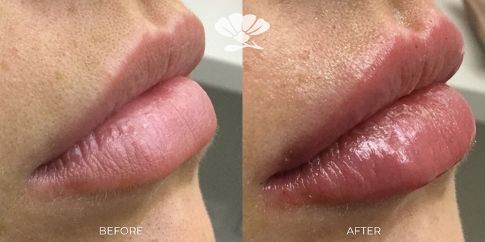 Lip filler before and after picture