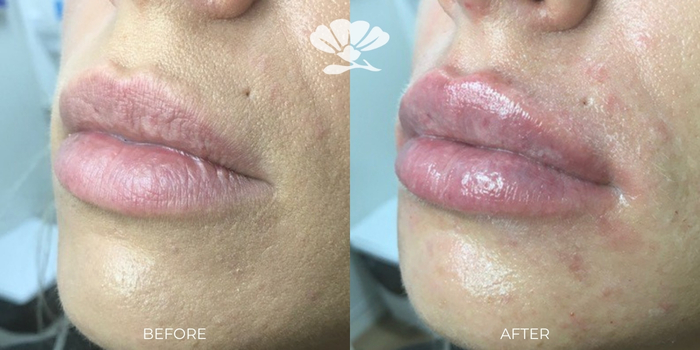 Before and after 1 ml lip filler Perth
