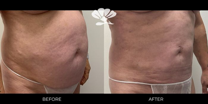 Perth abdominal Liposuction fat reduction