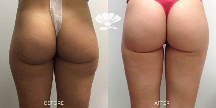 Thigh and Buttock Liposuction Perth