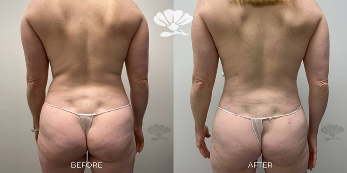 Liposuction Before and after Perth