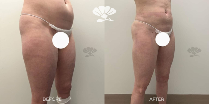 Vaser liposuction surgeon before after Perth