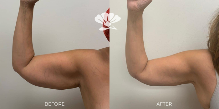 Arm liposuction Perth - Before and After