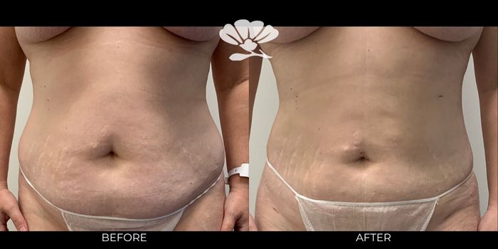 Liposuction stomach abdomen Perth
