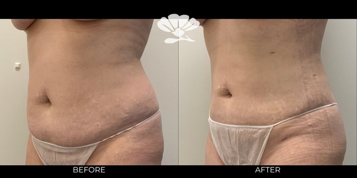 Perth liposuction before after waist
