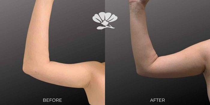 Surgical skin tightening for upper arm Perth Renuvion