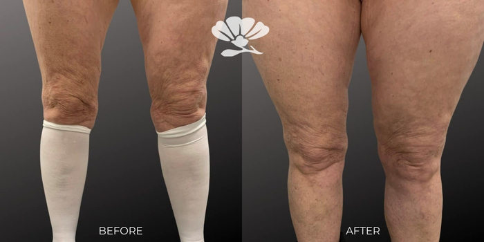 Fat Transfer and Renuvion skin tightening to knee divots.