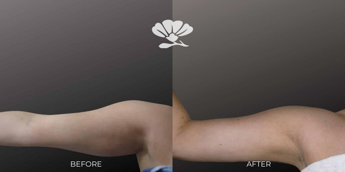 Upper arms surgical skin tightening Perth