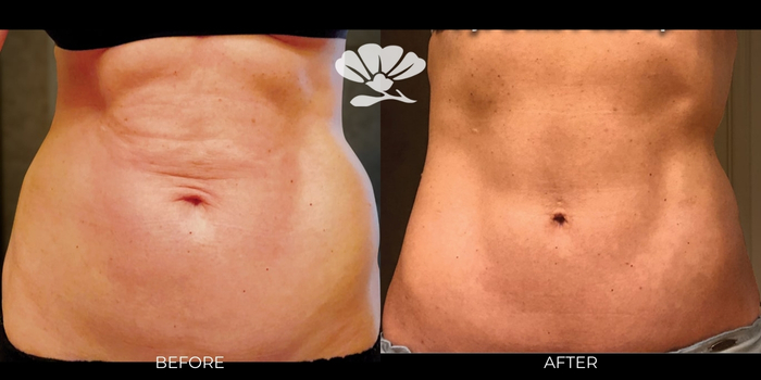 Renuvion skin tightening stomach before and after Perth