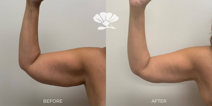 Skin tightening surgery for arms - Perth. Before and after