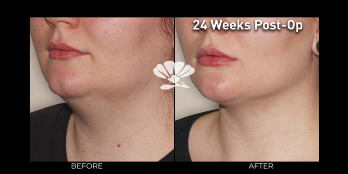 Surgical skin tightening for neck jowls Perth