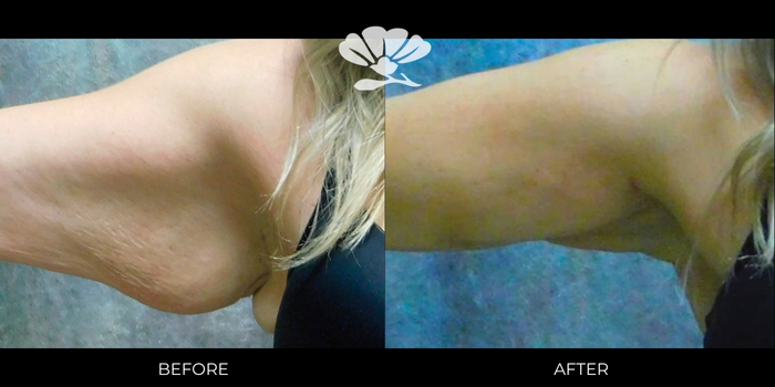Renuvion and Liposuction to arms before and after