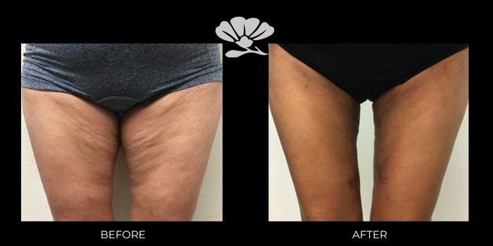 Renuvion and Liposuction to thighs - before and after