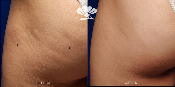 Buttock RF skin tightening Perth Before and after