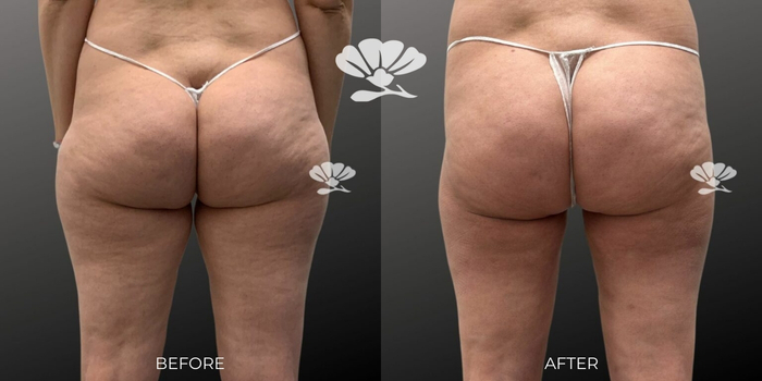vaser smooth cellulite reduction treatment before and after Perth WA