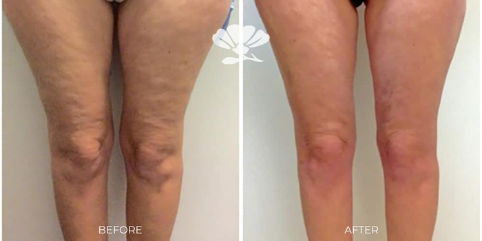 surgical cellulite reduction Perth Vaser smooth before and after