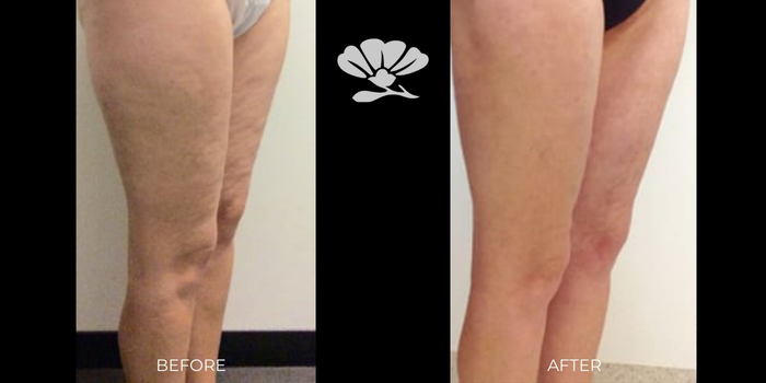 cellulite reduction Perth Vaser smooth before and after