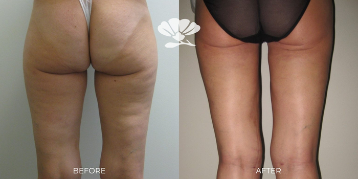 vaser smooth cellulite reduction treatment before and after Perth
