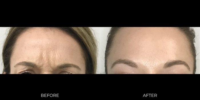Forehead feet anti-wrinkle injection before and after