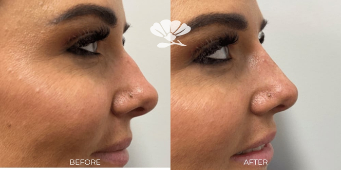 Non Surgical Injectable Rhinoplasty by Dr. Glenn Murray Before and After